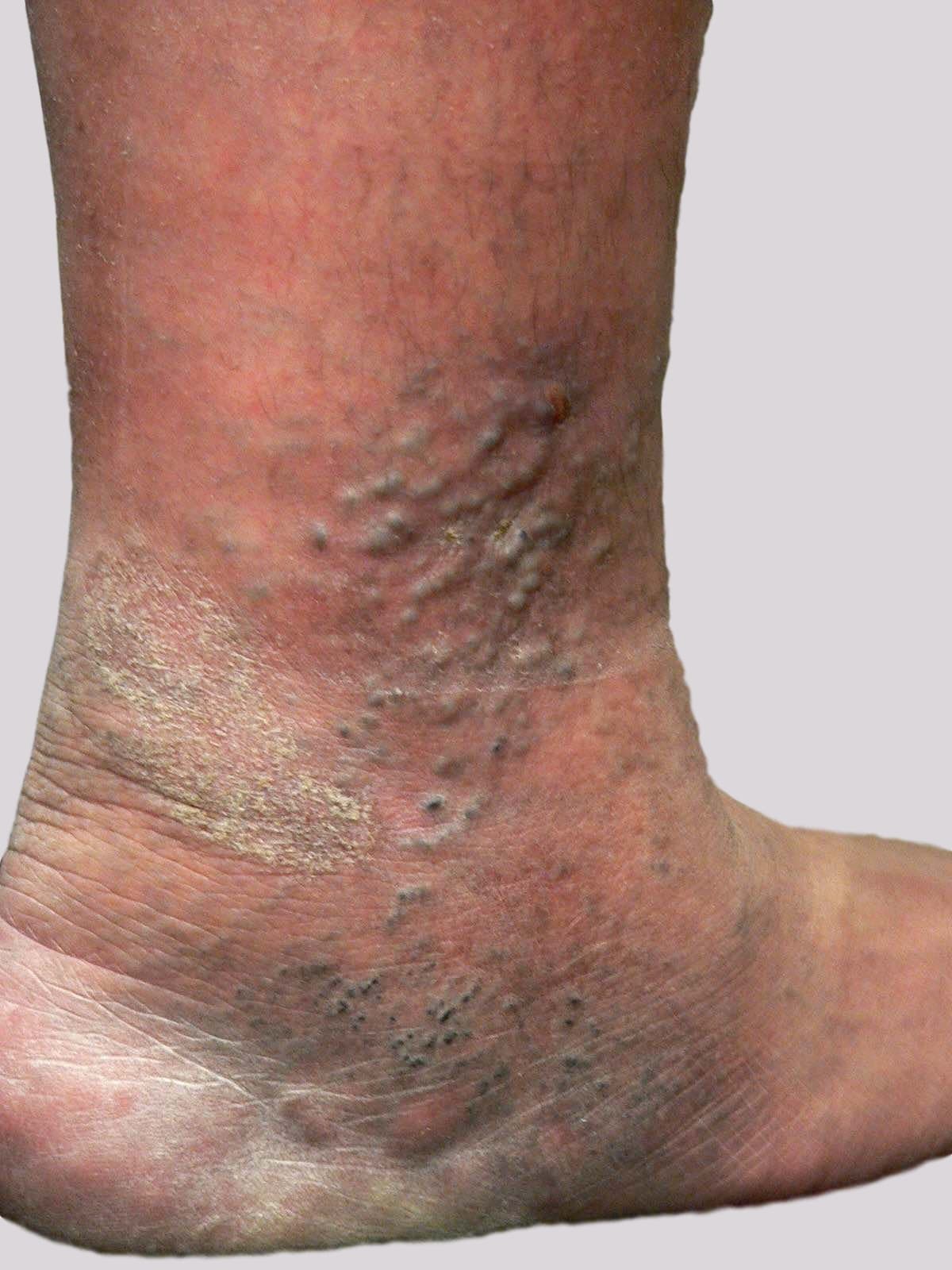 Eczema And Varicose Veins Indicating Problems