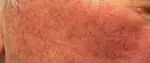 Facial Telangiectasiae or Spider Veins