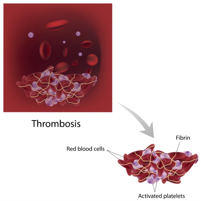 Stylised clotting illustration as occurring with thrombophlebitis migrans