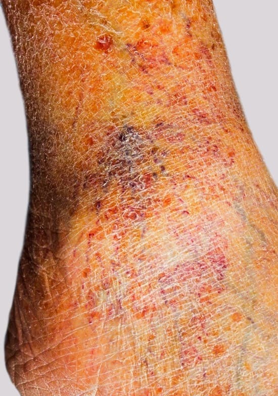 Itchy legs indicate underlying dry skin