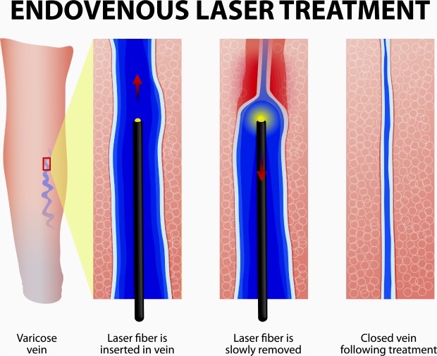 Laser varicose veins by endovenous laser fibre energy application from inside the veins shown diagrammatically