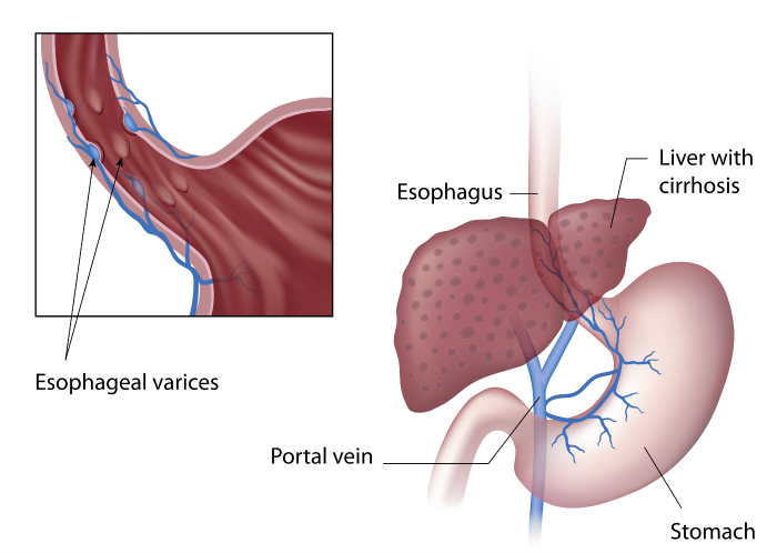 Bleeding esophageal varices varicose veins diagram showing varices location and portal circulation