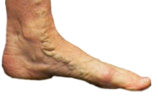 Varicose veins feet demonstrated with large one in inner aspect of foot