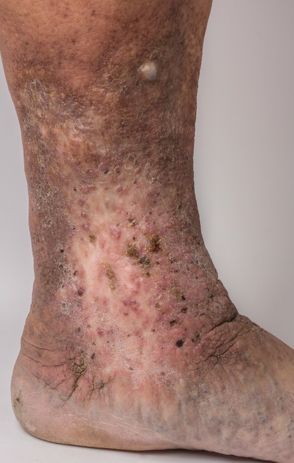 Varicose vein risks with lymphatic problems complicated by lipodermatosclerosis
