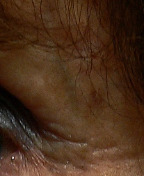 A reticular facial vein just under the eyebrow in older person