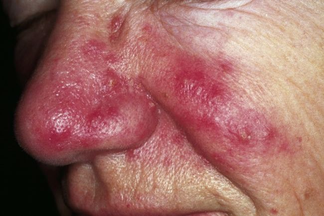 Facial spider vein treatment requires extra steps to control an underlying problem like rosacea - in appearance like acne without the blackhead comedones