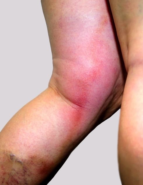 Superficial thrombophlebitis of inner thigh to knee with typical red inflamed flare about it