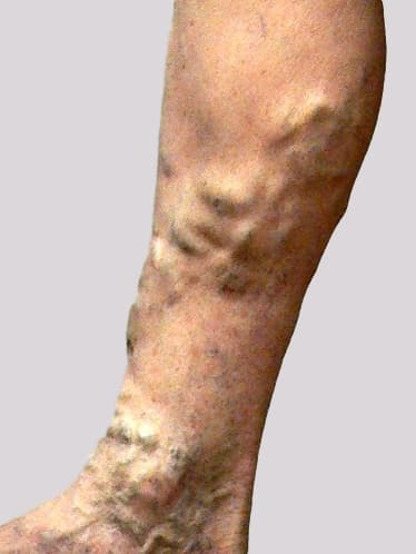 Eczema and varicose veins with large veins surrounded altered eczematous skin