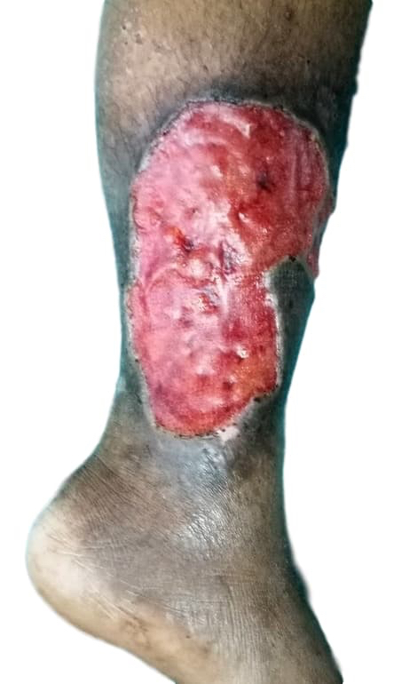 Varicose vein ulcer a large open tissue wound in the lower leg