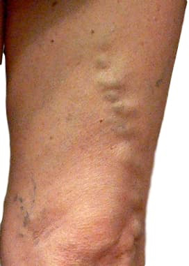 Varicose veins leg groin this in anterolateral vein distribution