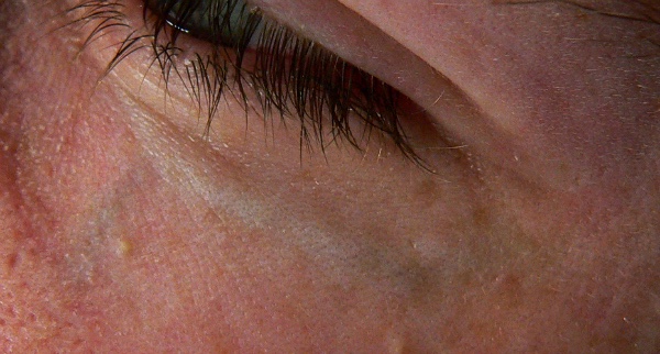 Blue veins under eyes can vary in extent