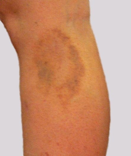 Burst vein on side of leg with resultant bruise