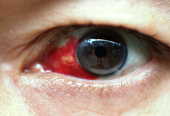 Burst vein in white of eye - a conjunctival haemorrhage