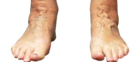 Varicose veins feet visible on top of feet