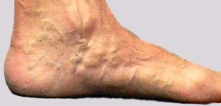 Leg veins pain with inside foot varicose veins may be all there is to see at times