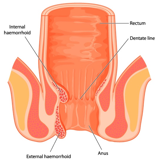Varicose veins and hemorrhoids differ in their anatomy and drainage.