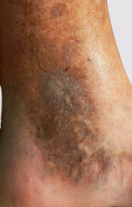 Smaller managed varicose vein ulcer