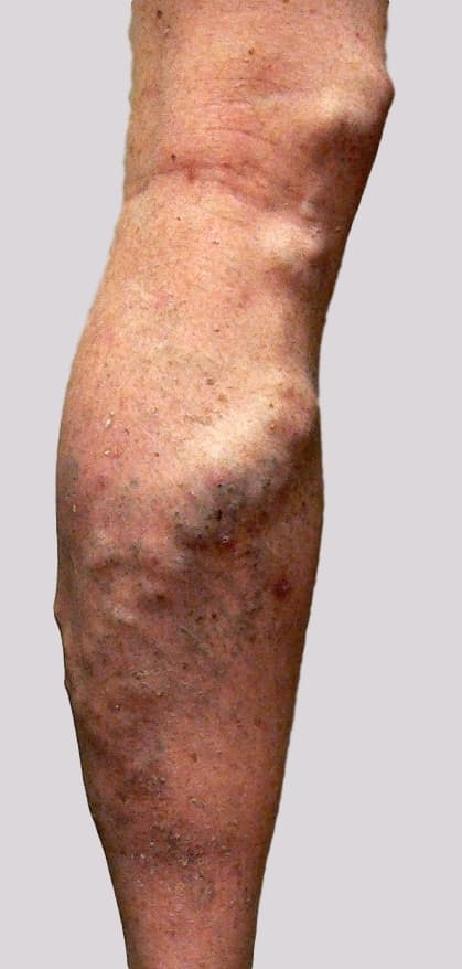 Varicose veins pain with vein inflammation at times