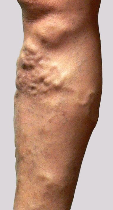 Large knotty varicose veins that could result in high flow bleeding from a burst vein with an injury