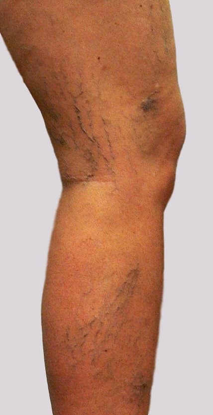 Leg Veins Pain can occur with lateral leg veins