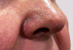 Veins on nose including the central underlying parts of the nose structure