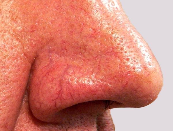 Veins on nose that are more extensive and obvious