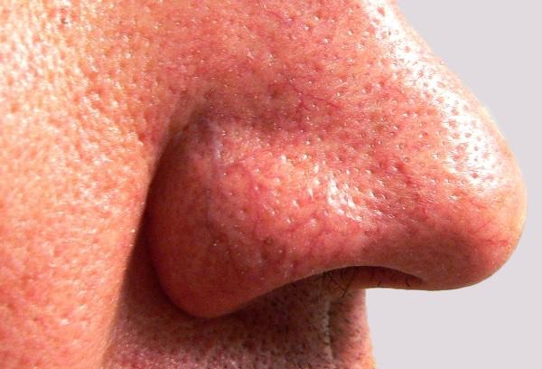 Veins on nose will increase over time with ageing and sun's damaging effects