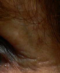 A reticular facial vein just under the eyebrow in older person