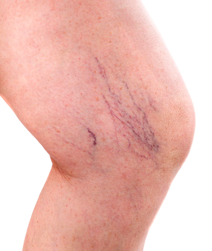 Varicose veins types with lateral veins appearing on the inside of the lower thigh