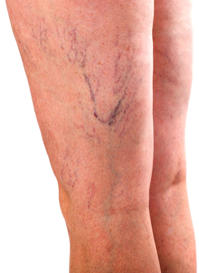 varicose veins types include the lateral vein system frequently with spider veins