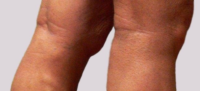 Varicose vein stripping will result in post-surgical scars.  Here some larger ones from prior instrumentation.