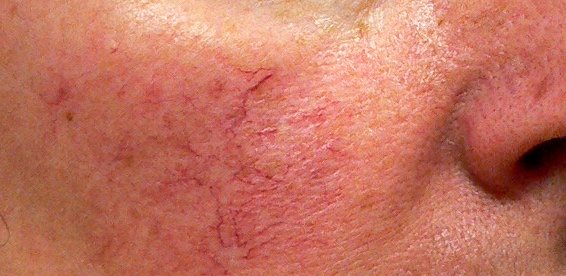 Unfortunately shallow spider veins on face can be very obvious