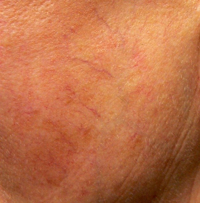 Spider veins on face in a different form