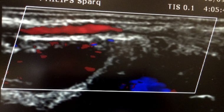 Vein treatment training needs to incorporate using the absolutely vital information supplied by colour duplex ultrasound imaging