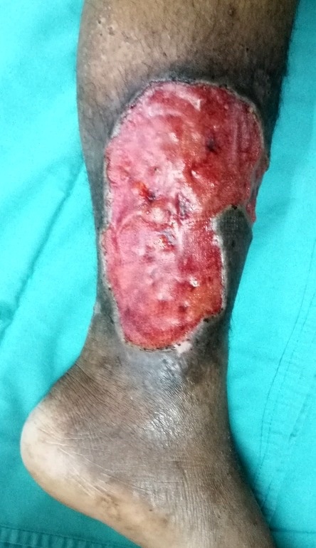 A Southern Cross affiliated provider for varicose veins can approve your treatment cover if you have had a varicose ulcer, maybe not as bad as this one.