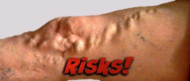 Varicose vein risks alert with large varicosities