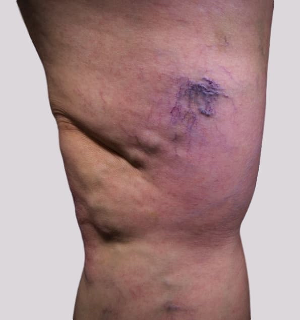 Varicose veins pain with veins over inside knee