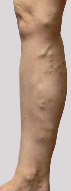 Varicose veins symptoms prominent veins inner leg