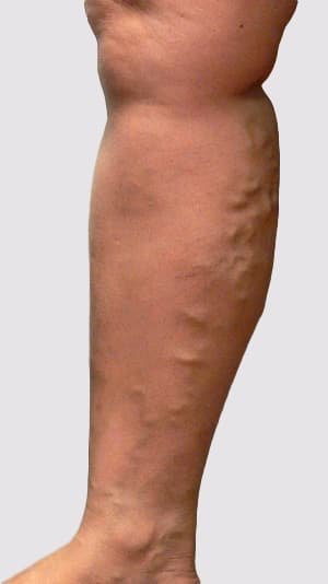 Varicose veins types demonstrating veins associated with the long saphenous vein