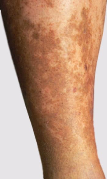 Varicose veins symptoms pigmentation changes