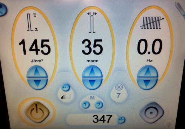 Laser varicose veins by the Cutera Xeo Cool Glide laser touch screen control panel showing power, pulse width, repetitions and beam size information